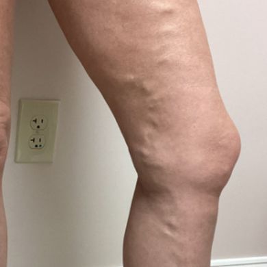 legs before.jpg